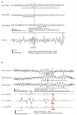 Mesial-Temporal Epileptic Ripples Correlate With Verbal Memory Impairment